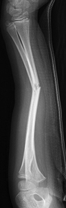 Figure 3_1387839-diaphysis_complete fracture_lateral_0002.JPG